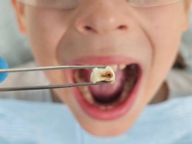 Best Emergency Tooth Extraction in Vineyard, CA